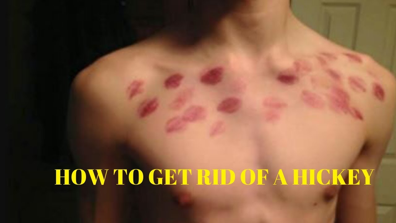 Rid how hickey get to of an How to