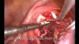 Uterine Myoma Laparoscopic Treatment
