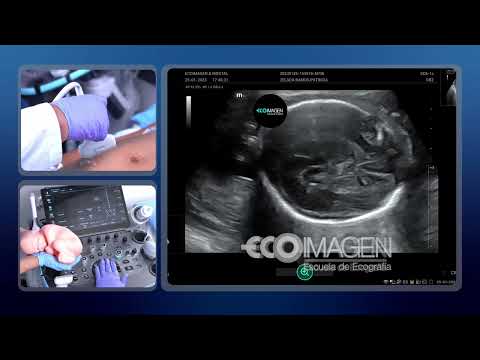 Vídeo: Como medir a biometria fetal?