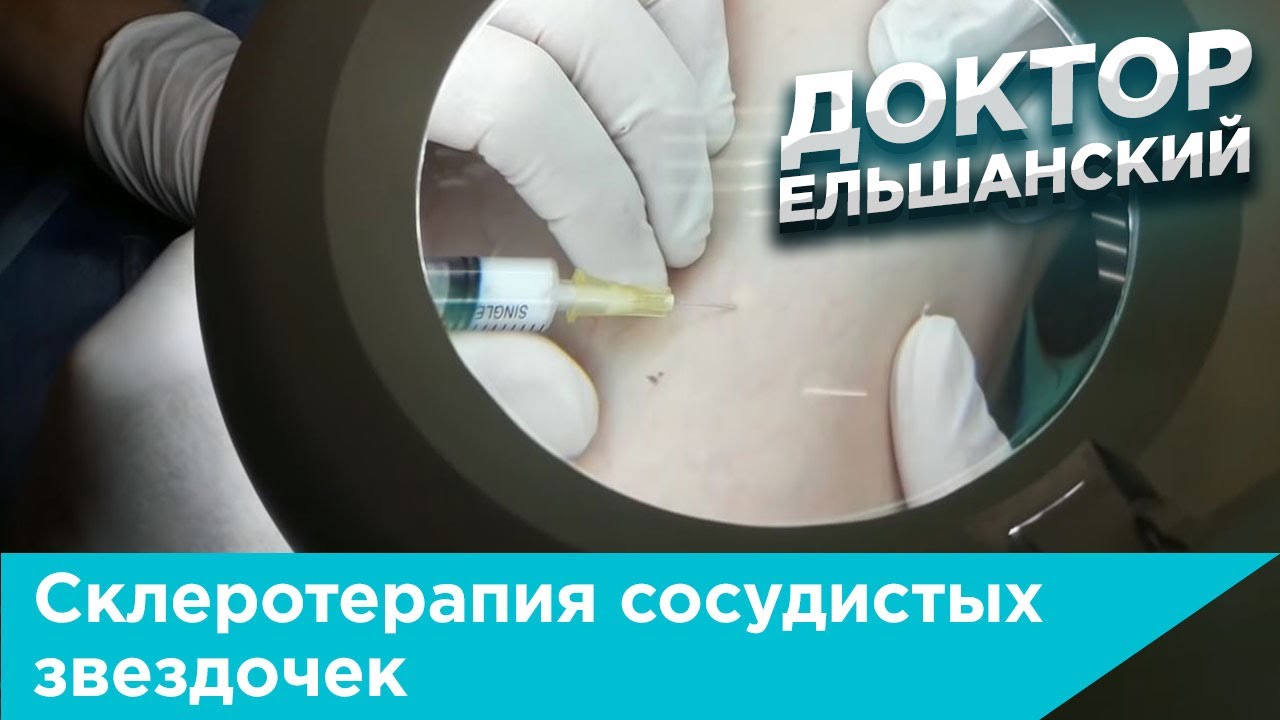 ⁣Склеротерапия сосудистых звездочек пеной и жидким склерозантом
