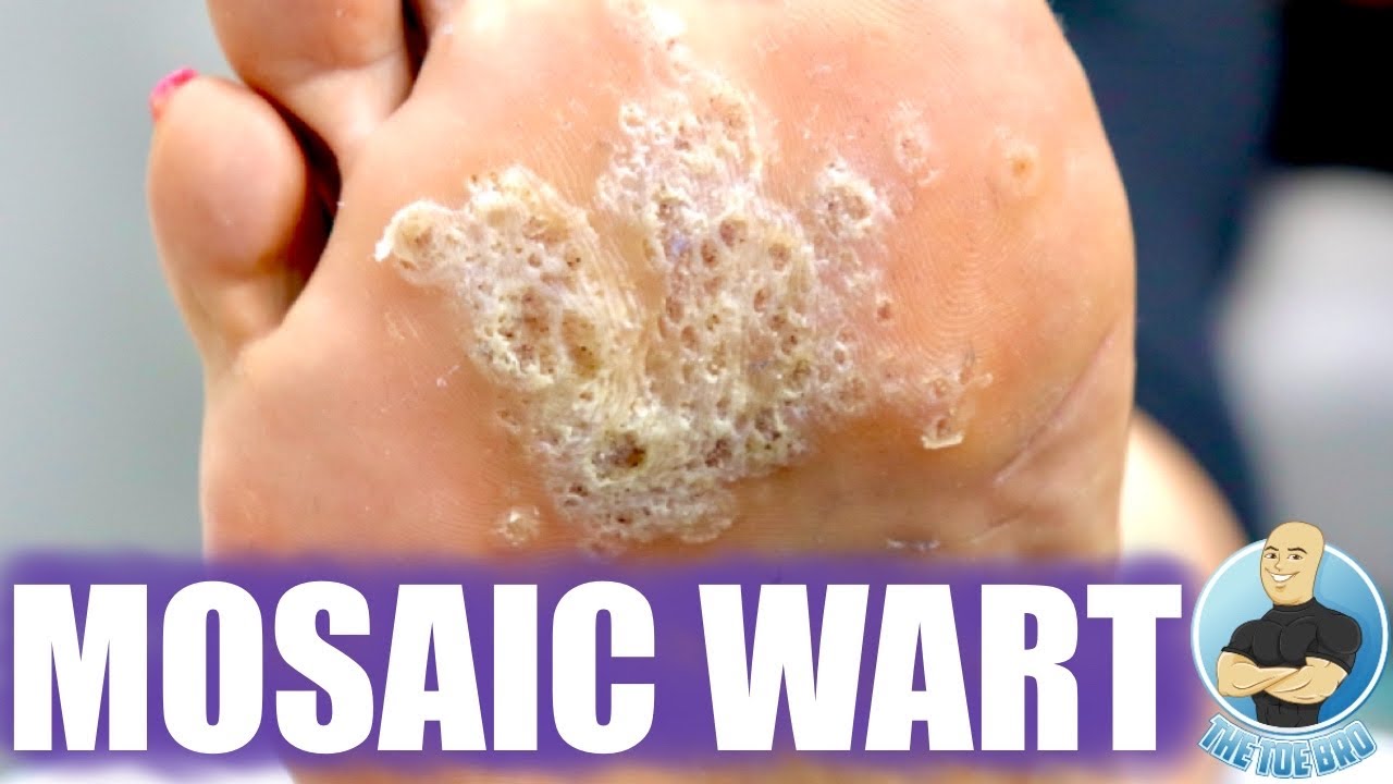 mosaic wart