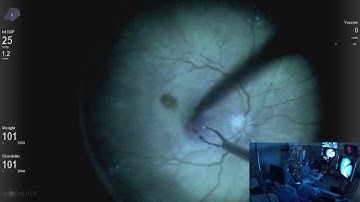 Phaco + PPV for ERM , Ngenuity enhancement filters Lukan Mishev live stream