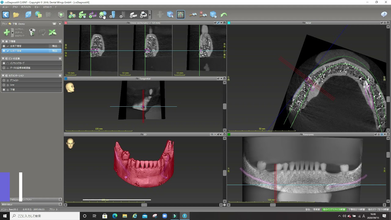 Straumannガイドを操作してみた