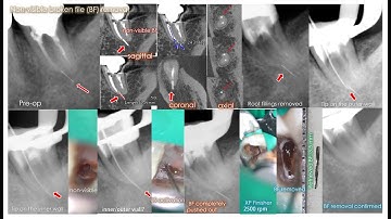 Removal of the nonvisible broken file extruded beyond the AF with XP Finisher/XPFを使った根尖孔外の見えない破折器具除去