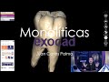 Caracterizaciones de Monolíticos en exocad - Juan Carlos Palma
