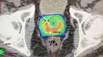 5-Session Radiation Treatment For Prostate Cancer (SBRT or Stereotactic Body Radiation Therapy)