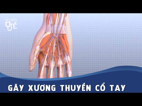 Video: 3 cách để chữa lành xương cổ tay bị gãy