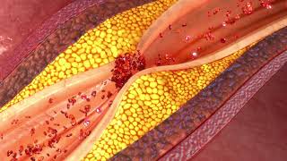Komplikationen Durch Diabetes Lernvideo Für Gesundheitsfachkräfte