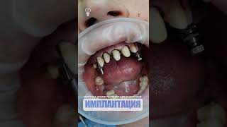 Обточка зубов. Реставрация и коронки. Teeth turning. Restoration and crowns. Implantation.