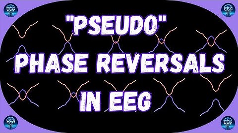 Recognizing "Pseudo-Phase Reversals" in EEG.