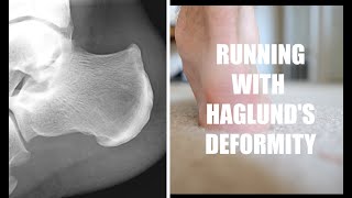 Running With Haglund's Deformity   The Galen Rupp Injury