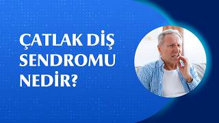 Çatlak Diş Sendromu Belirtileri Nelerdir ve Nasıl Tedavi Edilir?