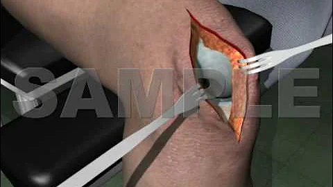 Femur Intramedullary (IM) Rodding