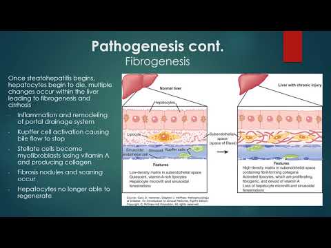 Cirrhosis Presentation Final Final