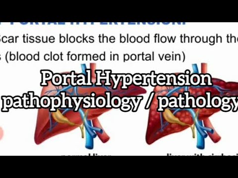 Portal Hypertension: Causes & symptoms, Hepatic Venous Pressure Gradient (HVPG) in urdu or hindi