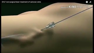 EVLT Laser Treatment for Varicose Veins: The Future of Varicose Vein Treatment Animation Video