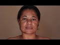 MAQUIANDO CLIENTE (MELASMA) 2