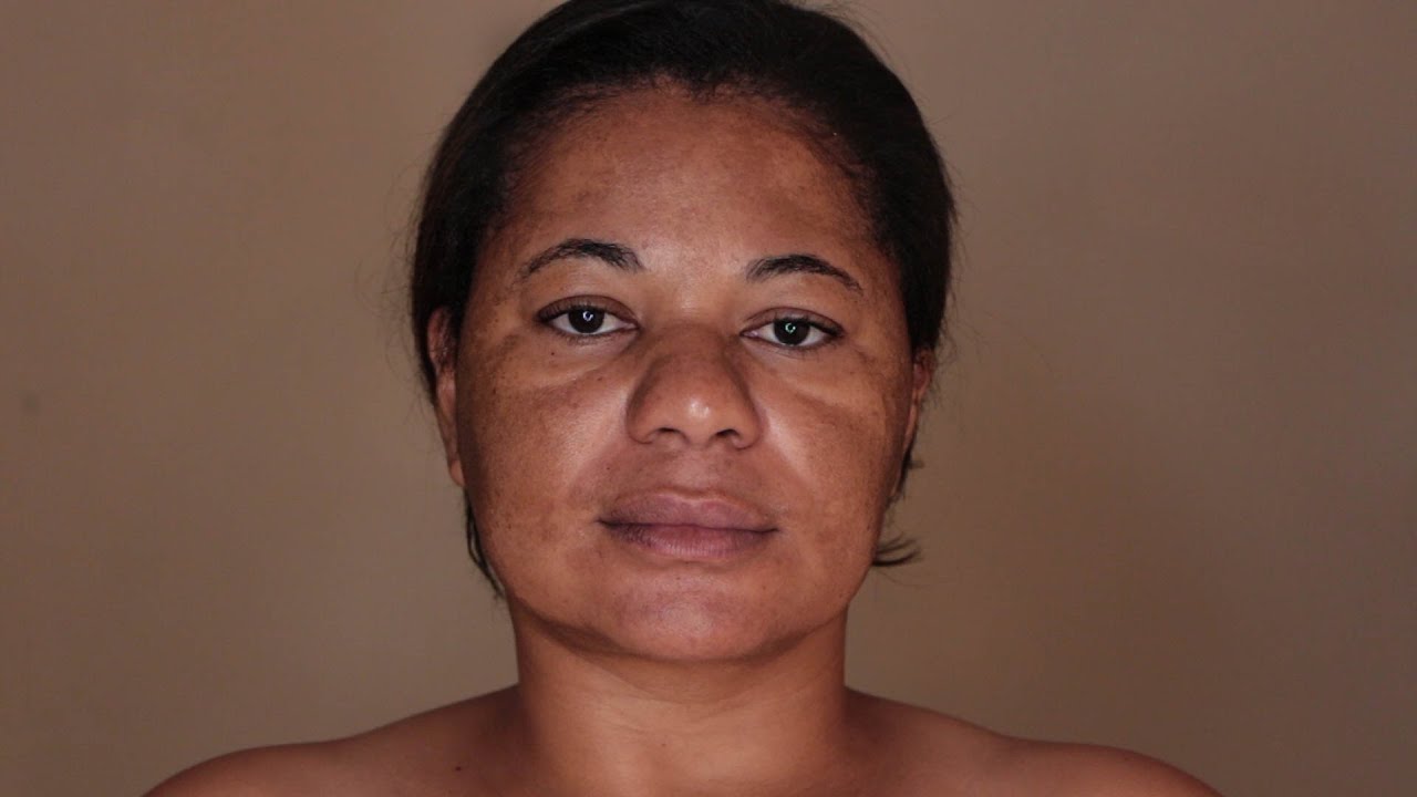 MAQUIANDO CLIENTE (MELASMA) 2