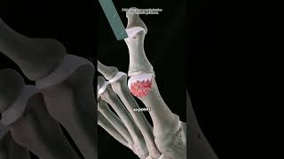 How Big Toe Fusion Surgery Is Performed (3D Animation)