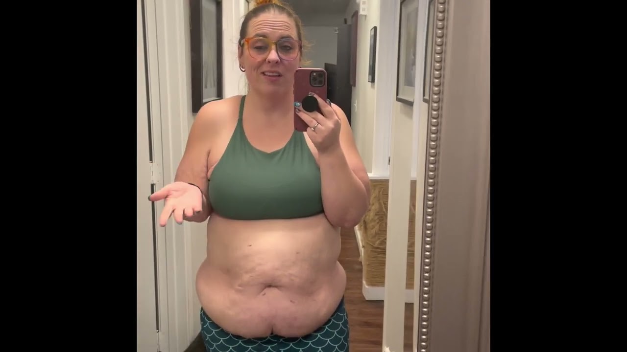 Bariatric Surgery Loose skin after losing 160 pounds post Gastric