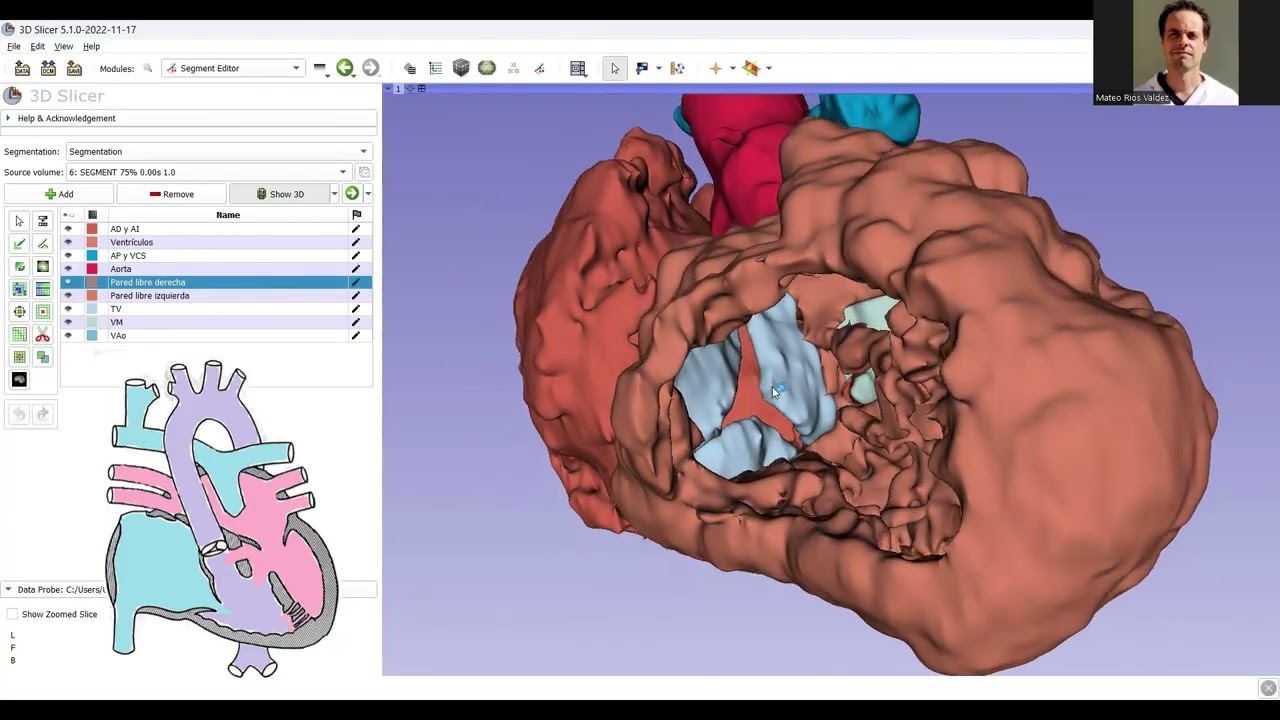 Doble tracto de salida de ventrículo derecho (DORV) +Glenn:  anatomía intracardíaca compleja