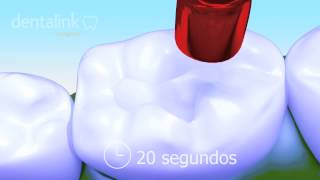 RESTAURACIÓN dental con resina  Video 3D paso a paso