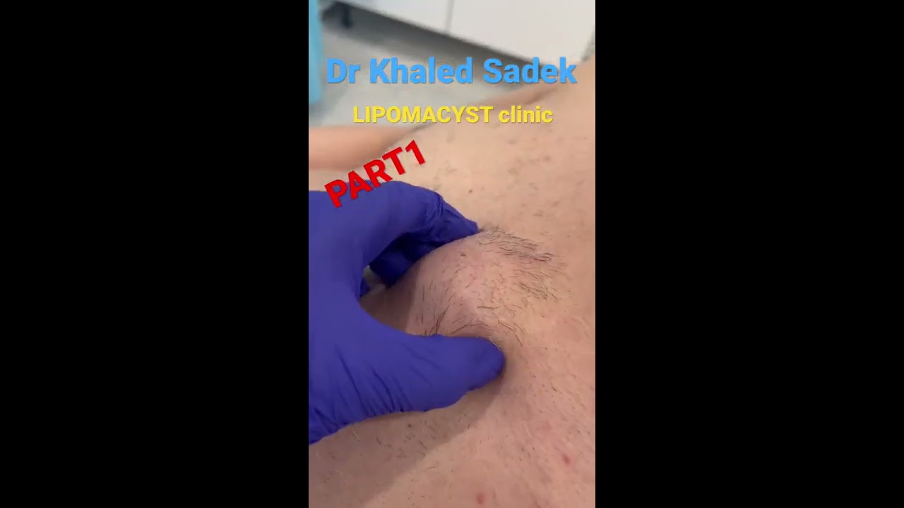 Massive Cyst Removal Shorts Blackheads Skincare Dr Khaled Sadek