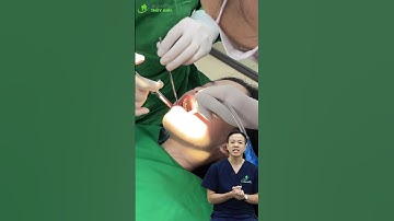 Nhược điểm của nhổ 1 lần 4 răng khôn? #nhakhoathuyanh #dentist #nhorang