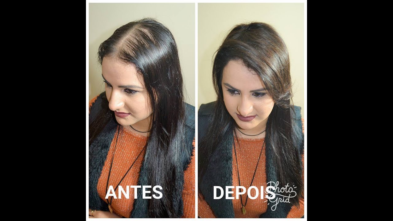 PREENCHIMENTO NA REGIÃO FRONTAL