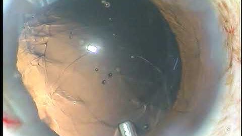How to place the trailing haptic in the capsular bag  :  Pradip Mohanta