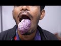 Worlds Largest Tongue Hemangioma