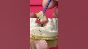 3-Unit Bridge with a single Implant