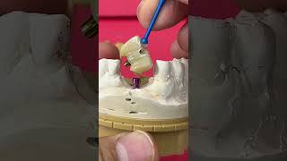 3-Unit Bridge with a single Implant