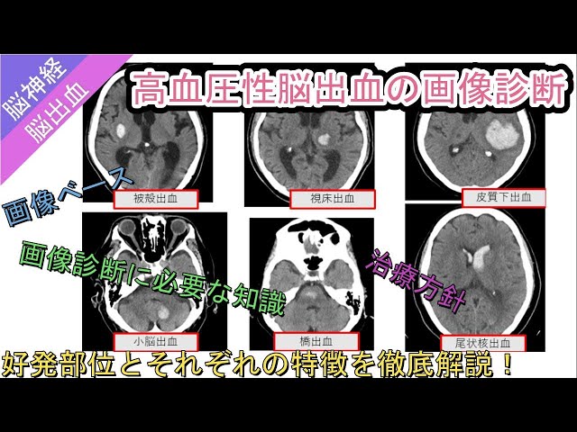 脳の画像診断 肝性脳症・肝硬変の頭部MRIの画像診断は？T1WIで高信号？