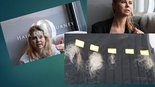 Beginning stages of hair loss by mamalize 51 views 1 year ago 5 minutes, 45 seconds