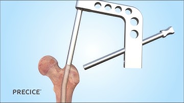 PRECICE Antegrade Femur Animation