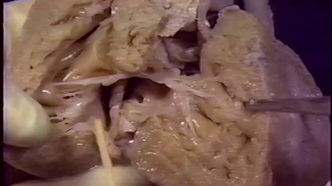 Double outlet right ventricle 김정선