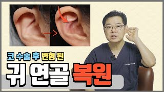 귀연골 코수술 하고 귀모양이 변했어요. | 귀연골 복원.