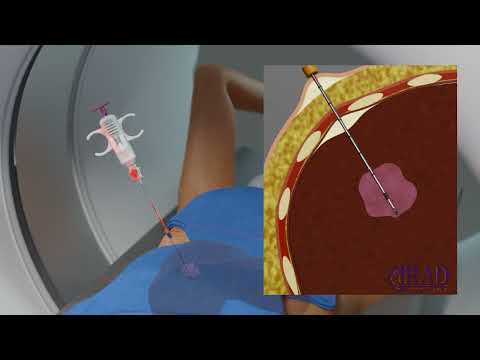 Biopsy of Liver