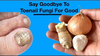 How To Treat Toenail Fungi Fast Diy Homemade Treatment