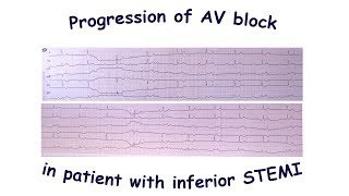Progression of AV block in patient with inferior STEMI