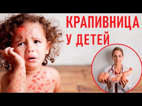Как выглядит крапивница у детей?