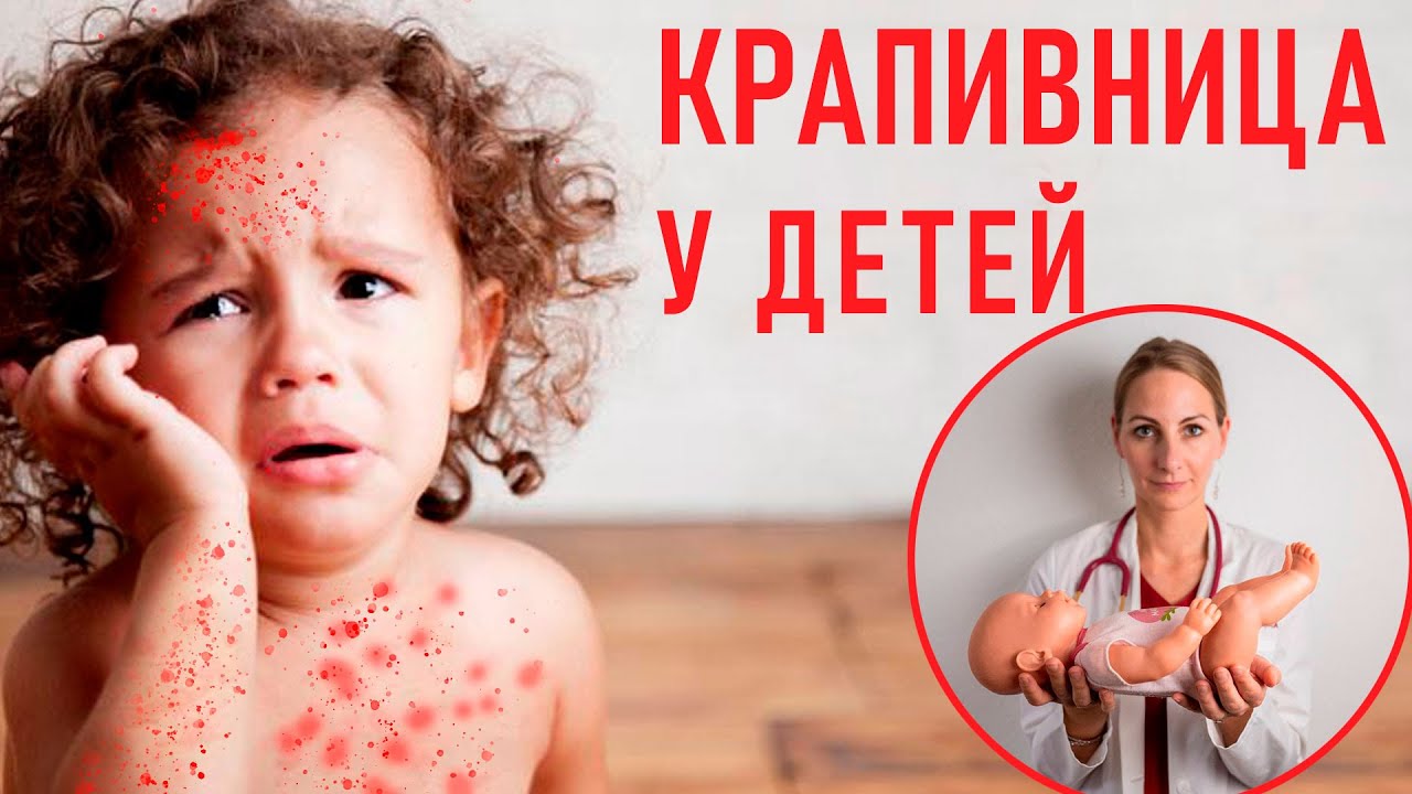 Крапивница у детей