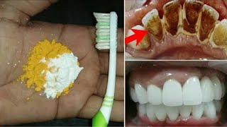 2 నిమిషాల్లో ఎంతటి గారపట్టిన పసుపు పళ్ళు అయిన ముత్యాల్లా మెరిసిపోతాయి..white teeth home remedies screenshot 4