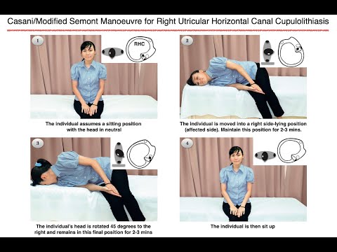 Casani/Modified Semont Manoeuvre