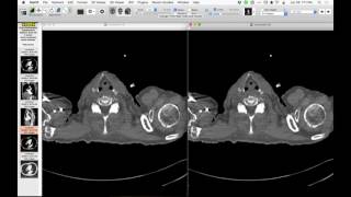 STR Cardiothoracic Case Webinar 6/29/2017