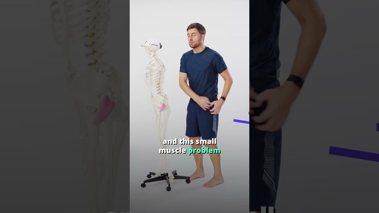 Piriformis Syndrome Sciatica