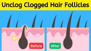6 Expert Tips to Unclog and Prevent Blocked Hair Follicles! How to Treat Clogged Hair Follicles