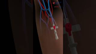 Iv Insertion 💉 Intravenous Catheter ⚕️ 3D Medical Animation