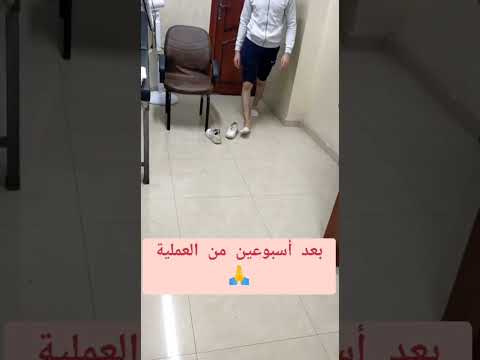 بعد اسبوعين من عملية استعدال الساق دكتور محمد سلمان